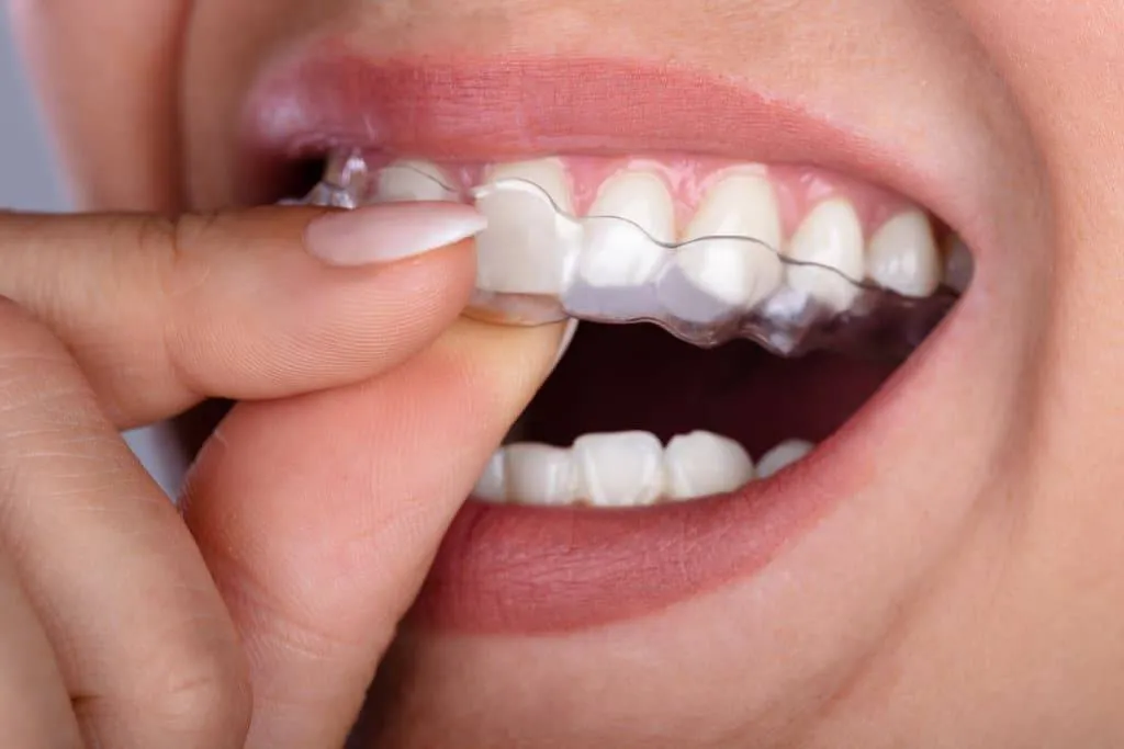 Beautiful smile with clear aligner