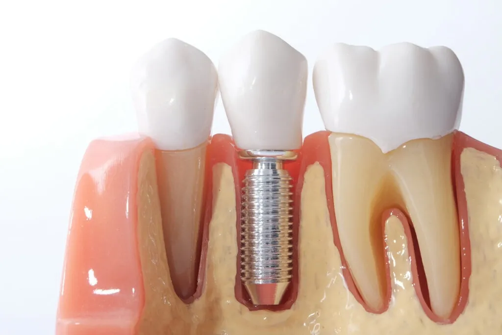 Generic Dental Implant Study Analysis Crown Bridge Demonstration Teeth Model