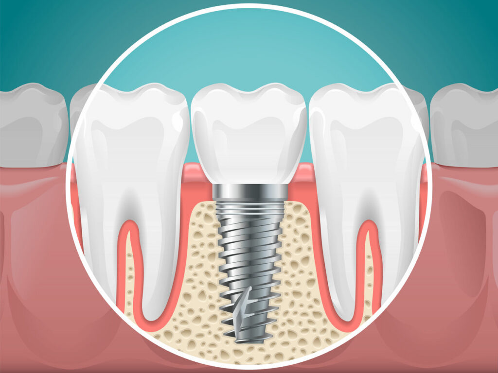 Stomatology illustrations. Dental implants and healthy teeth. Vector health tooth and implant stomatology, dentistry installation and fixture
