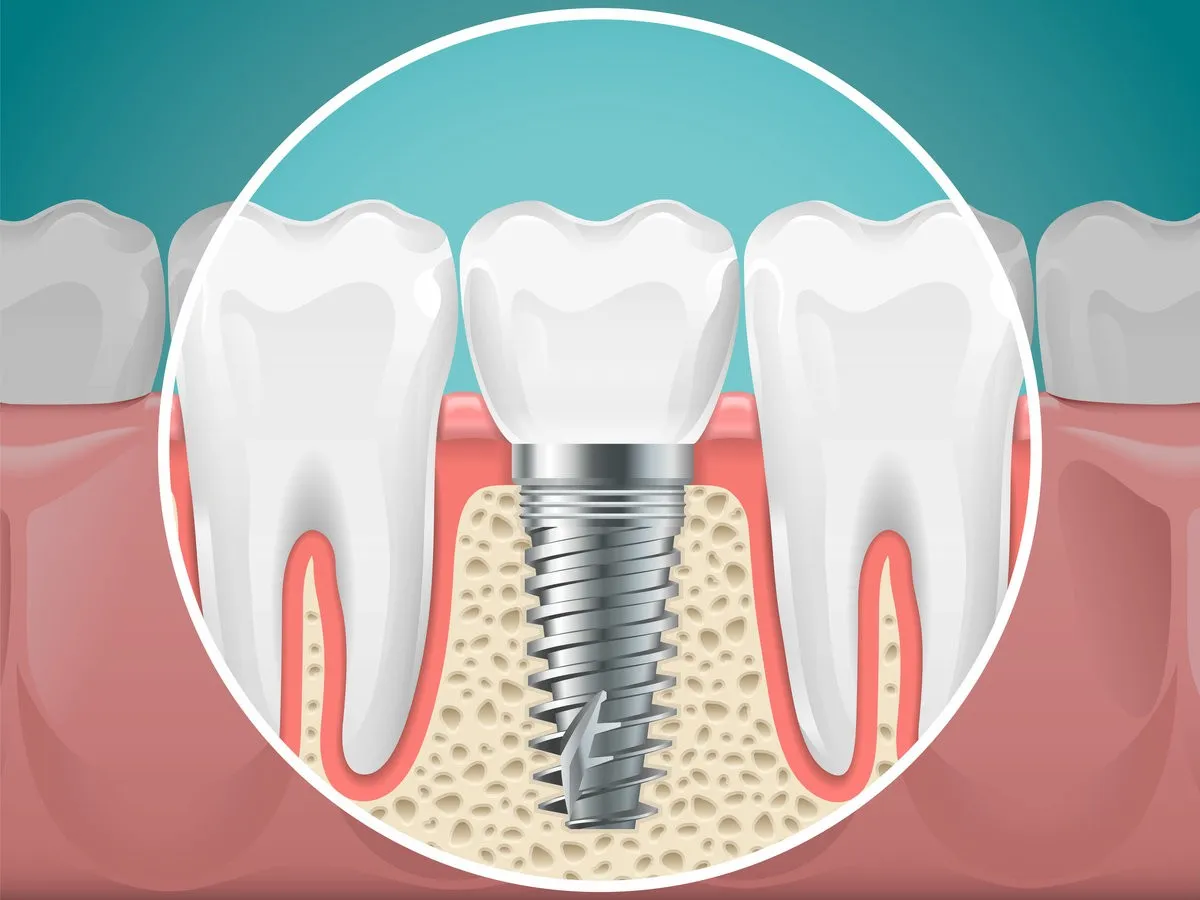 Stomatology illustrations. Dental implants and healthy teeth. Vector health tooth and implant stomatology, dentistry installation and fixture