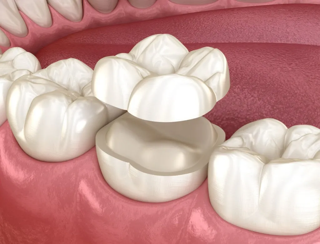 Onlay ceramic crown fixation over tooth. Medically accurate 3D illustration of human teeth treatment
