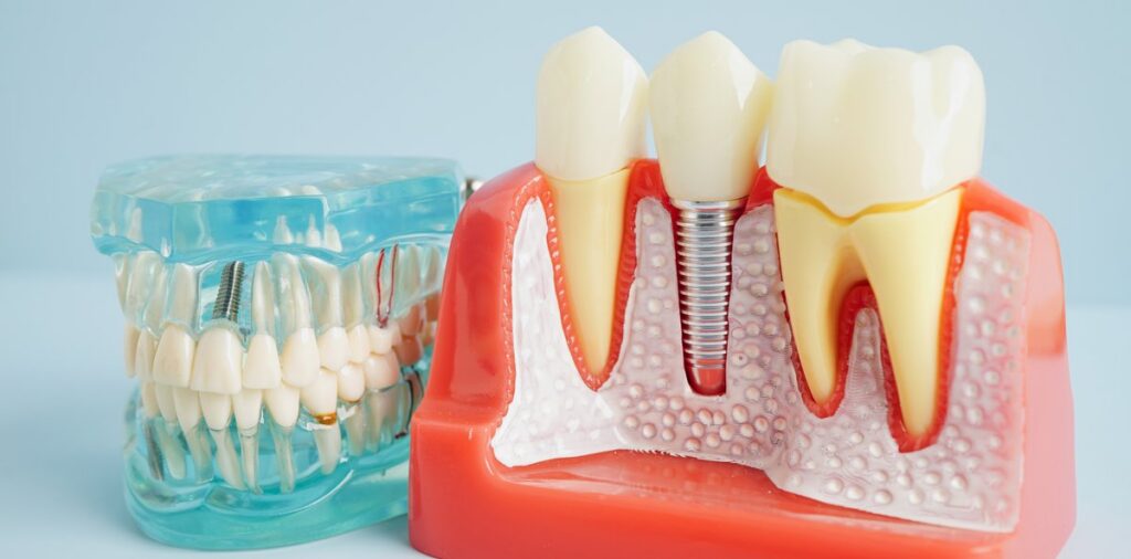 Dental implant model showing artificial tooth root placed into the jawbone