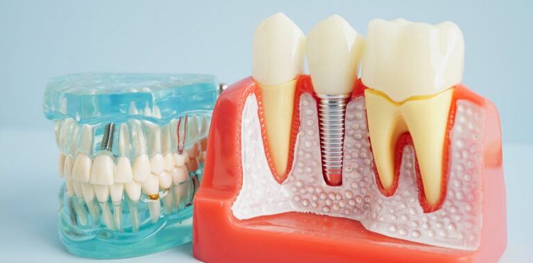 Dental implant model showing artificial tooth root placed into the jawbone